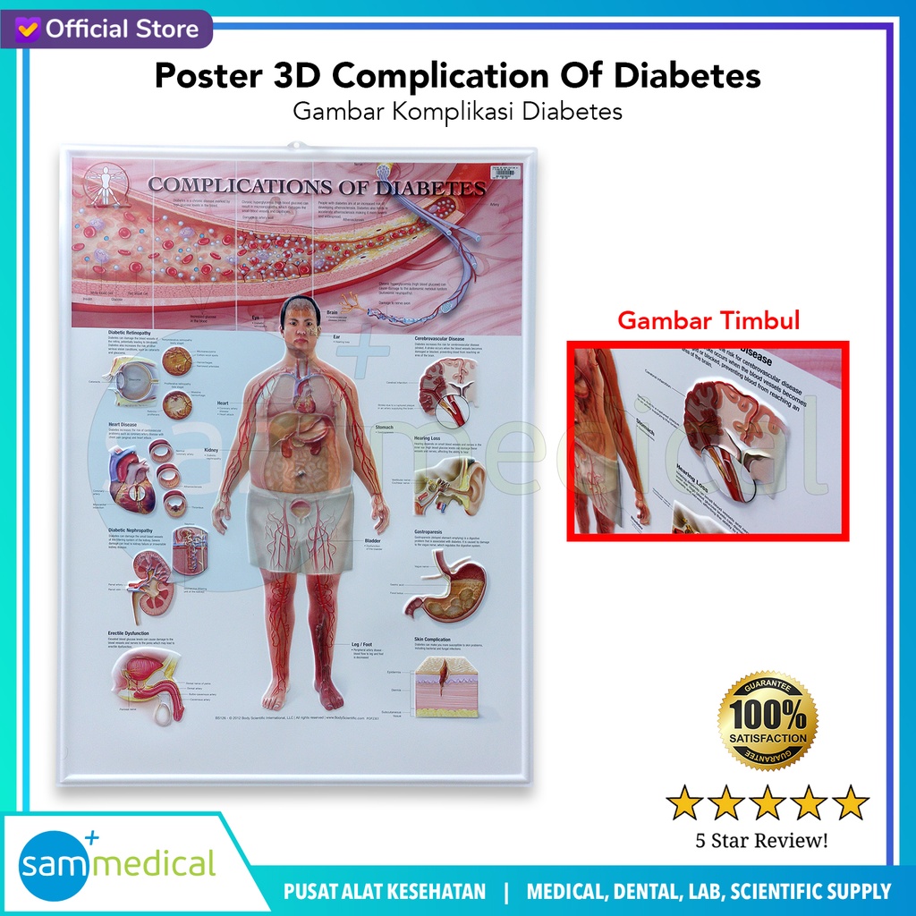 Poster 3D Complication Of Diabetes BS 126